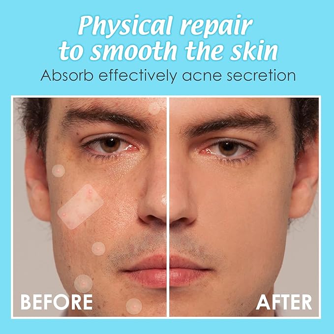 Large Pimple Patches Acne Patches hydrocolloid Bandages for Face Forehead Chin Body Chest Back Blemish Patch with Multiple Sizes (134pcs)