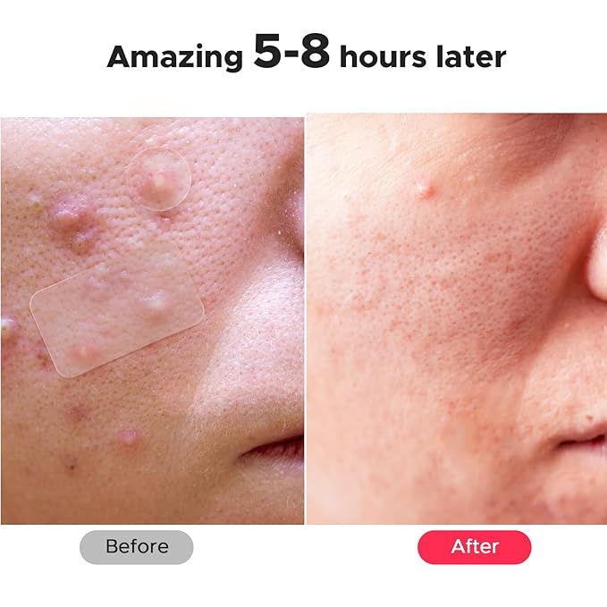 LitBear Large Pimple Patches, 5 Sizes 156 Patches Big Acne Patch, 60 XL Hydrocolloid Patch for Full Face, Forehead, Chin, Nose, Body, Back, Neck & Chest, Stirp, Square Large Hydrocolloid Bandages