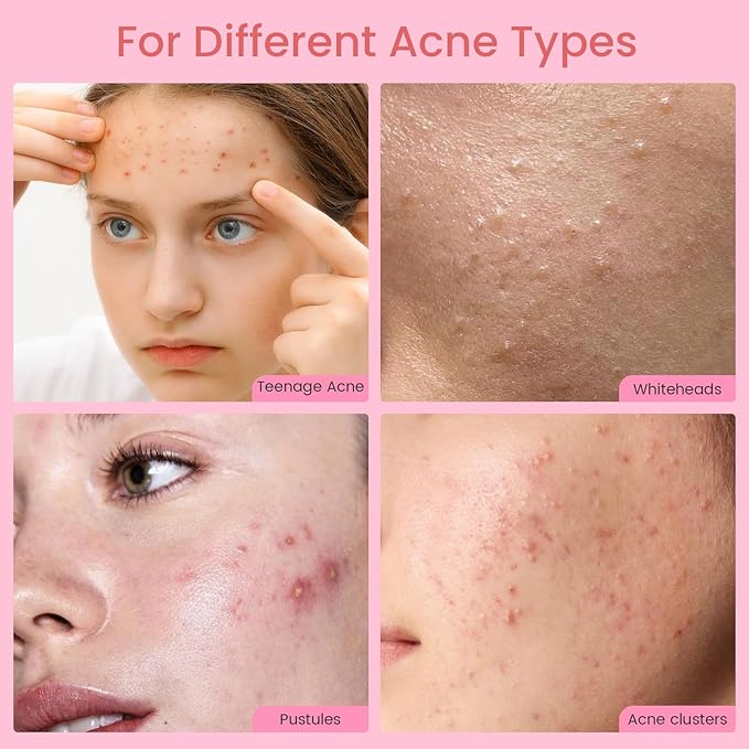 AUSLKA Pimple Patch Bulk, 720 Pimple Patches for Face, Hydrocolloid Spot Patch Stickers for Zits& Blemishes, Suitable for Body, Cheek, Forehead, Chin and Back (8mm, 10mm,12mm)