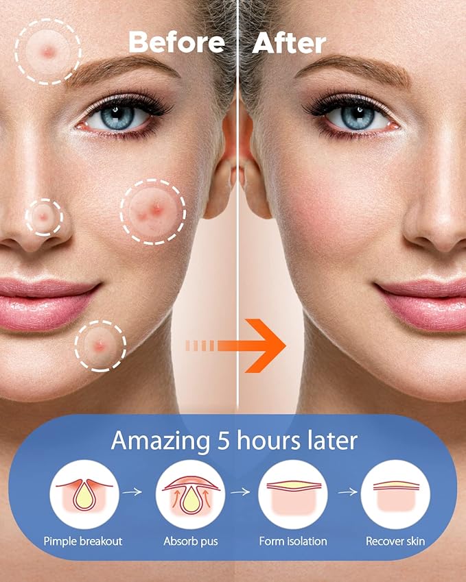 LitBear Acne Pimple Patches- Day and Night 4 Sizes 360 Dots Thin & Thick Hydrocolloid Patches with Witch Hazel, Tea Tree & Calendula Oil, Extra Adhesion Pimple Patches for Face Zit Patch Acne Dots