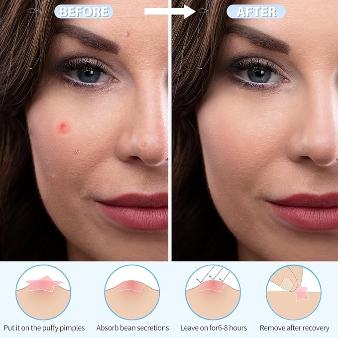 Pimple Patches for Face, Colorful Hydrocolloid Acne Patches for Covering Zits and Blemishes, 3 Sizes of Ultra-Thin Spot Patch for All Skin Types(200 Counts)