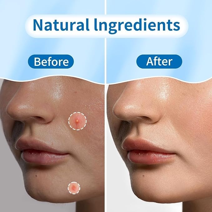 180 Counts Original Pimple Patches for Face, Hydrocolloid Acne Pimple Patch with Tea Tree Oil for Party Gift Covering Zits Blemishes