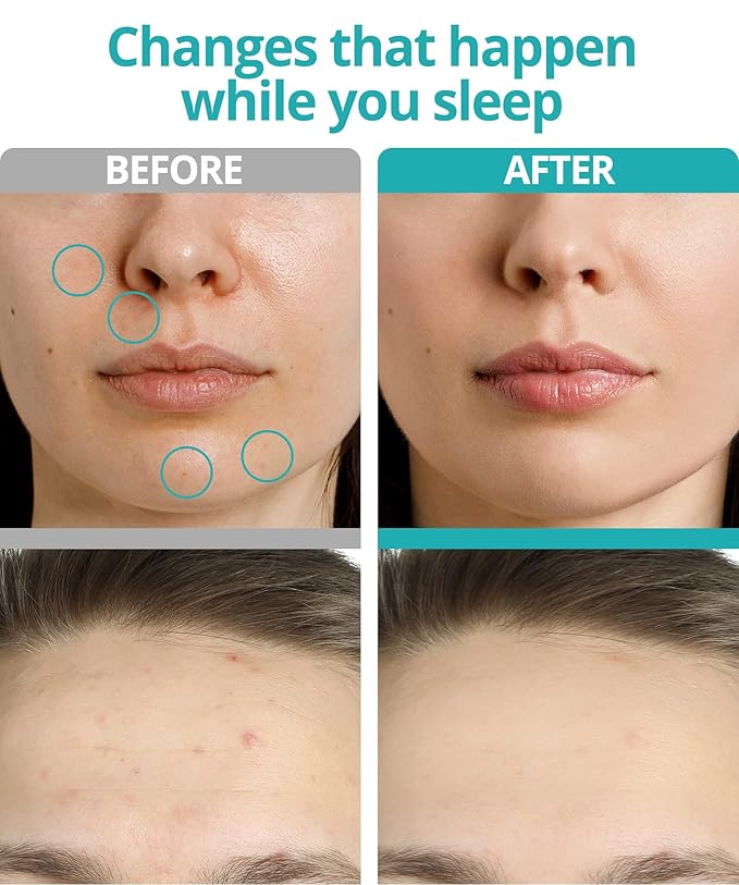 Dissolving Microdart Acne Patch for Deep Blemish - 18 Patches - Fast Acting Microdart Pimple Patches for face - Hyaluronic Acid, Tea Tree Zit patches for face - Hydrocolloid Bandages