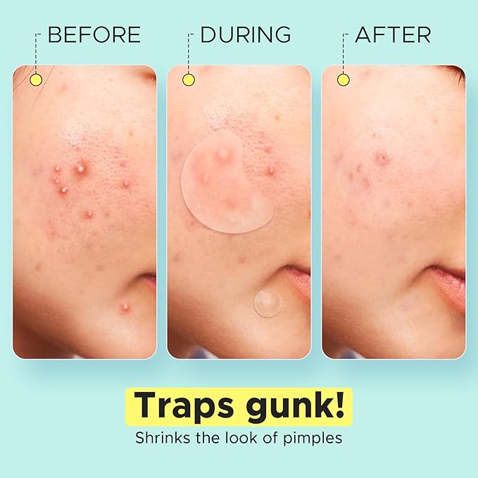 LitBear Pimple Patches for Face, Large Acne Patch, XL Hydrocolloid Bandages,Zit Stickers for Forehead, Chin, Nose, Body, Back, and Chest, Includes Crescent, Square, and Dot (5 Sizes, 507 Patches)