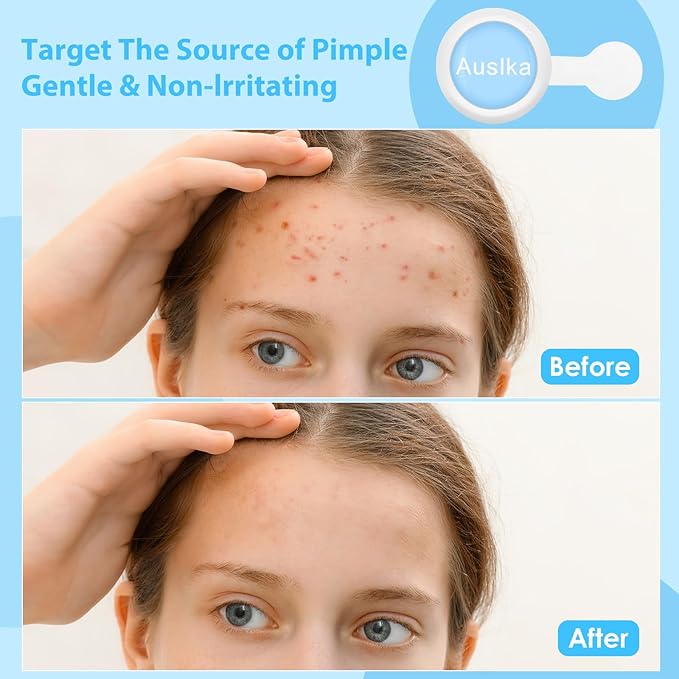 AUSLKA Light Therapy Pimple Patch, LED Red and Blue Light Hydrocolloid Zit Patches, Spot Dots for Blemishe, 6-Packs, Use 6-8 hours (Blue, Eliminate Pimple Patch)