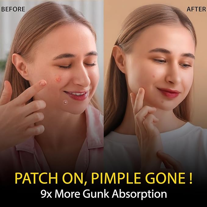 Hydrocolloid Acne Pimple Invisible 144 Patches with Tea Tree Oil & Salicylic Acid I Ultra Thin Absorbing Spot Stickers for Face, Skin I Covers Blemishes, Zits I Different Sizes 8mm, 12mm