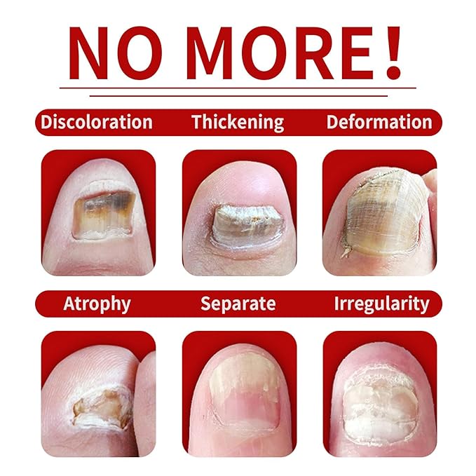 Ginger Nail Treatment, Nail Treatment,