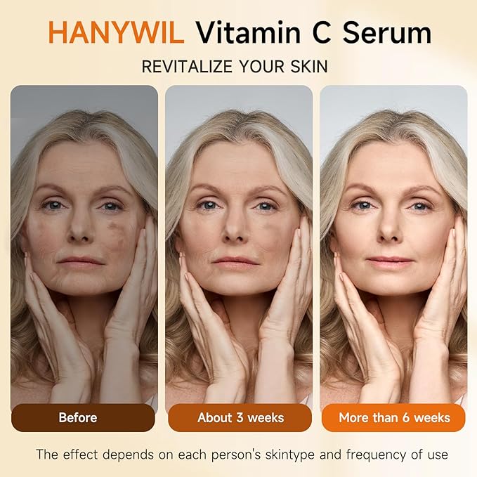 HANYWIL 20% Super Vitamin C Serum, Dark Spot Remover for Face, Hyaluronic Acid Total Package Serum, Targets Age Spots, Hydrates and Wrinkle Reduction 1.7fl oz