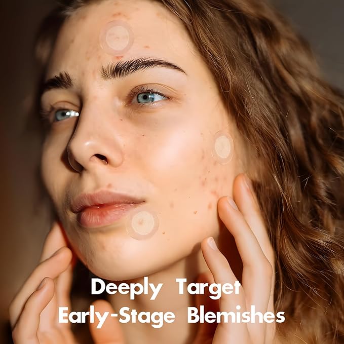 Microdart Pimple Patch for Deep Blemish, Hydrocolloid Acne Patch with Salicylic Acid, Nicotinamide, CICA, Tea Tree Oil Targe Early Stage & Underground Zit Breakout (16 Counts)