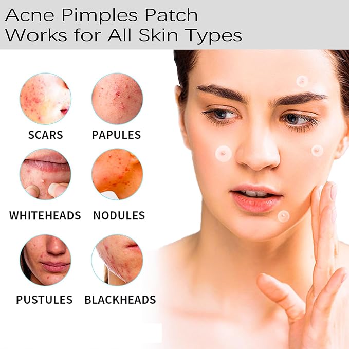 Acne Pimple Patches Invisible for Face Forehead, 12mm/9mm Hydrocolloid Acne Patches Stickers with Tea Tree Oil to Fast Relieve Zits, Acnes (5 Sheets/180 Patches)