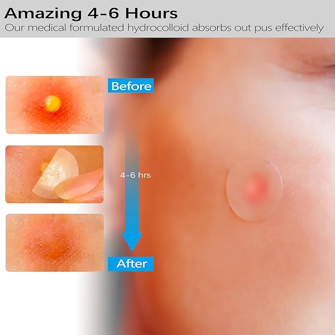 Acne Pimple Patches Invisible for Face Forehead, 12mm/9mm Hydrocolloid Acne Patches Stickers with Tea Tree Oil to Fast Relieve Zits, Acnes (5 Sheets/180 Patches)