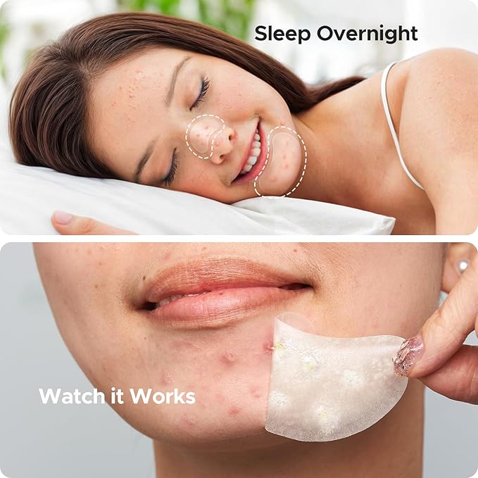 TKTK Chin Pimple Patches (100 Count 6 Sizes), XL Contoured Hydrocolloid Chin Patch 62x42 mm, Large Acne Patch for Face Blemishes Zit Breakouts, Maximum Absorption Overnight Stickers