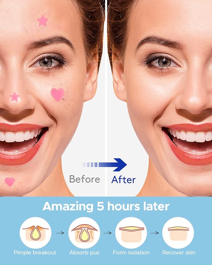 LitBear Acne Patch Pimple Patch, Pink Heart & Star Shaped Absorbing Cover Hydrocolloid Patches For Face Zit, Acne Dots, Tea Tree Oil + Centella (108 Count (Pack of 1))