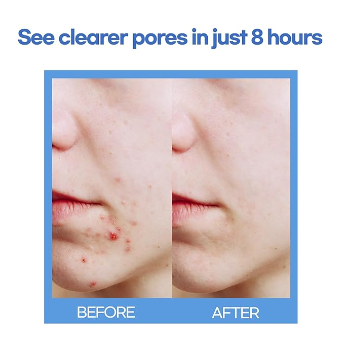 Epielle Acne Patch Shapes Edition, Hydrocolloid Dressing, Fun for Parties, Sleepovers, Girls' Nights, Teenager Gift (Daily Patch, 72ct)