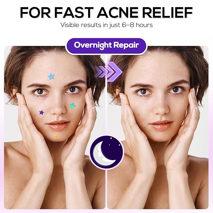 Star Pimple Patches 360 Counts, Hydrocolloid Pimples, w/Salicylic Acid & Tea Tree Oil, Pimple Patches for Face - Conceal Whiteheads, Blackheads And Blemishes, Ance (10mm,12mm,14mm)