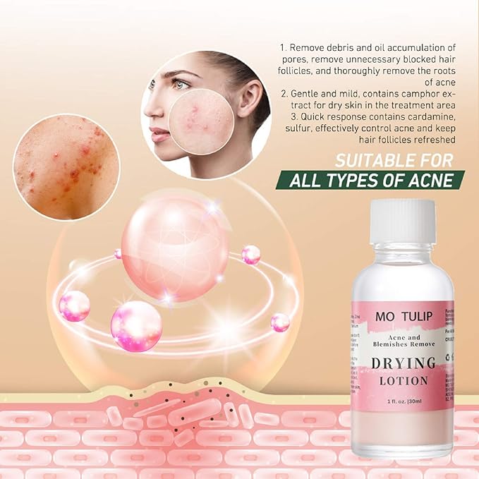 MO TULIP Acne Drying Lotion, Overnight Acne Acid and Acne Spot Treatment for Face and Body, Pimple Lotion Spot Treatment, Dry Out Pimples, Blemishes, and Clean pores (1OZ)