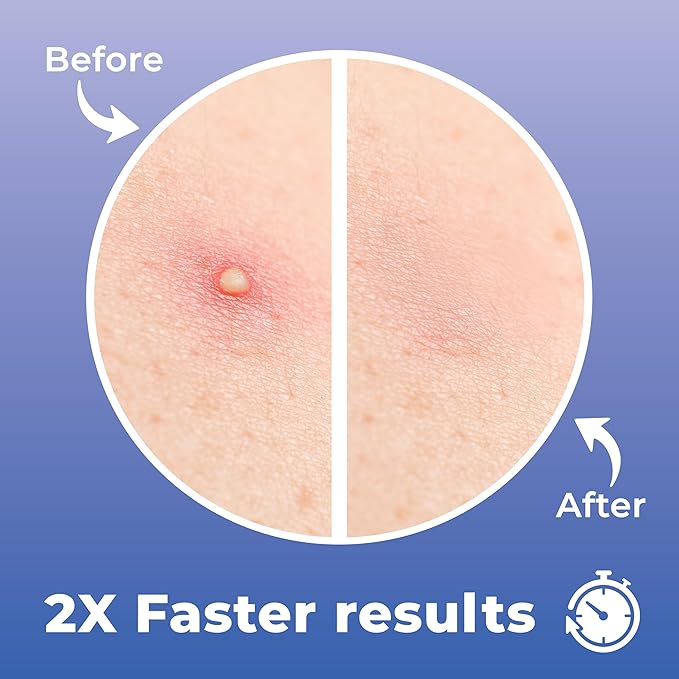 Star Pimple Patches for Face (240 Patches) with Hydrocolloid Only, Cute Acne Patches, Star Patches for Teens and Adults Zit Patches Stickers for Face, Fun Blemish Patches