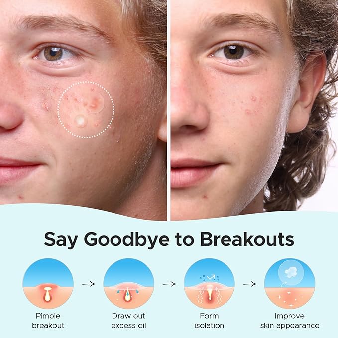 TKTK Hydrocolloid Acne Patches, Pimple Patches for Face with Tea Tree & Calendula Oil - 4 Sizes Clear Cover Stickers, Invisible for Day & Night Use (180 Count)