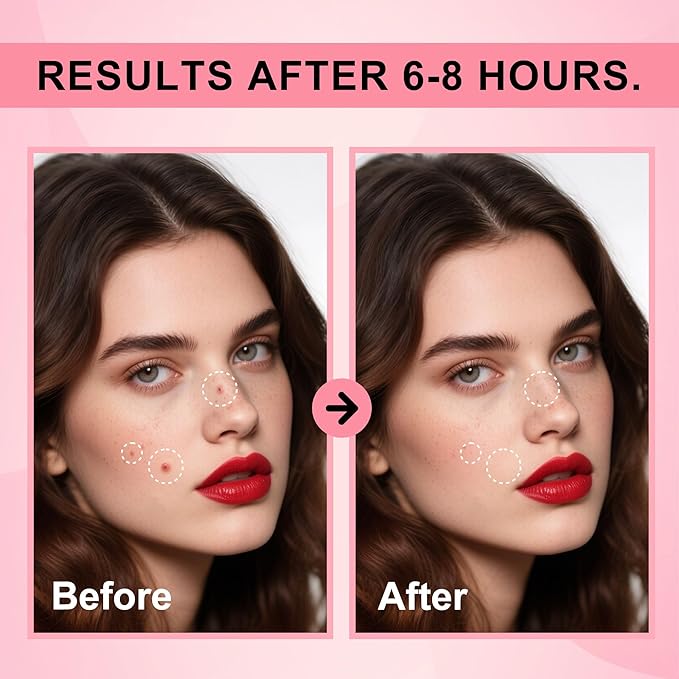 Pimple Patches for Face,Pimple Patches Cute,Acne Patches with Hydrocolloid, Salicylic Acid & Tea Tree,Treatment for Breakouts, Absorbs Zits & Blemish,Hydrocolloid Acne Patch for Face (72 Count)