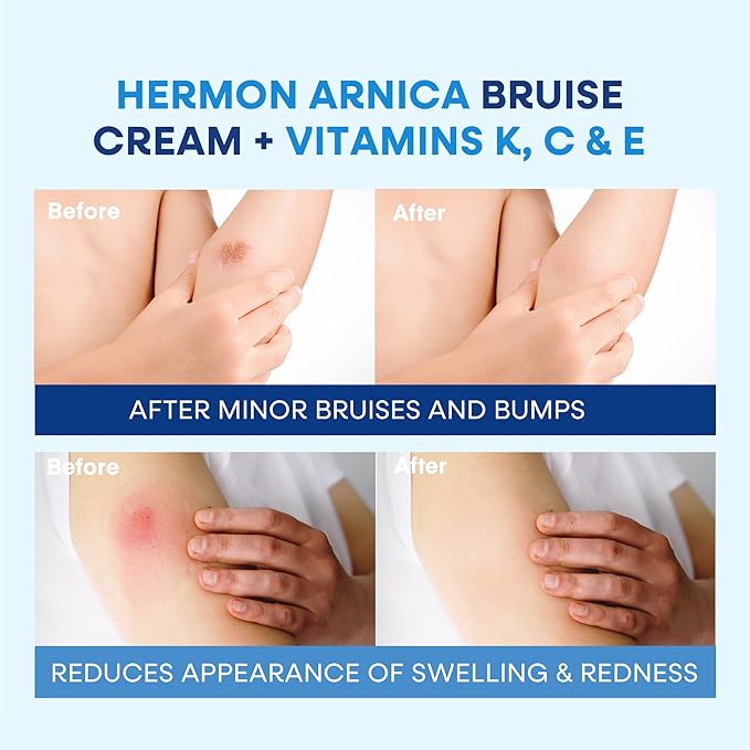 Hermon Arnica Bruise Cream Extra Strength: Fast-Acting for Bruising & Swelling on Thin Skin - High Strength Arnica Montana with Vitamins K, C & E–Hydrating Moisturizer for Face (4 oz(pack of 1))