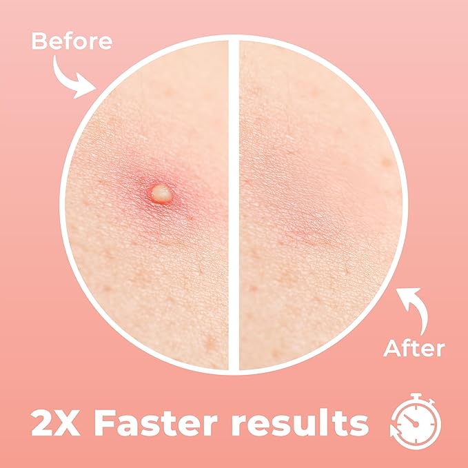 Micro Needle Pimple Patch (18 Pack) - Hydrocolloid Micropoint Pimple Patch For Acne & Pimples, Eliminate Pimples Overnight, Microdart Patch, Micro Dart Pimple Patches