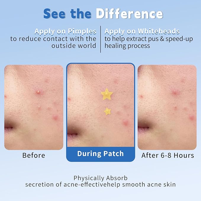 Pimple Patches for Face, Colorful Hydrocolloid Acne Patches for Covering Zits and Blemishes, 3 Sizes of Ultra-Thin Spot Patch for All Skin Types(200 Counts)