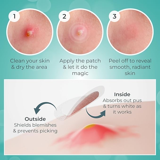 – 144 Count Hydrocolloid Acne Patches with Salicylic Acid, Tea Tree Oil & Centella – Clear Pimple Patch for Overnight Zit & Blemish Spot Treatment for Teens & Adults