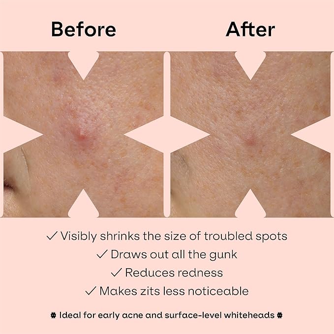 Pimple Patches Cute for Face (28 Unique Acne Patch Designs) | Hydrocolloid, Salicylic Acid, Tea Tree | Strong Adhesion, Waterproof, Vegan | Confidence Patch Be You