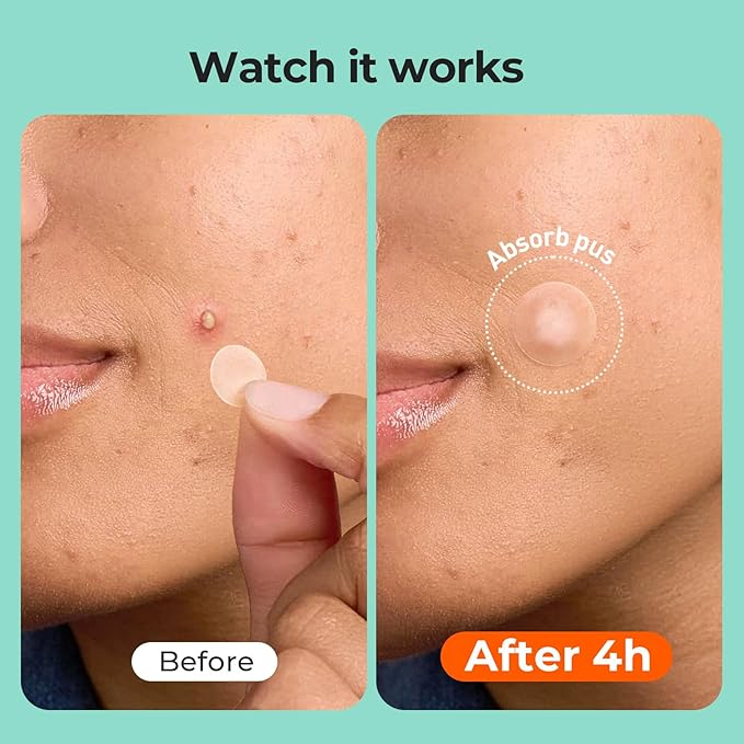 TKTK Pimple Patches for Face, 6 Sizes Hydrocolloid Acne Patch Variety, Large Acne Stickers for Cheeks, Forehead, Chin, Nose, Back Blemishes Zit Breakouts (4 Shapes 356 Count)