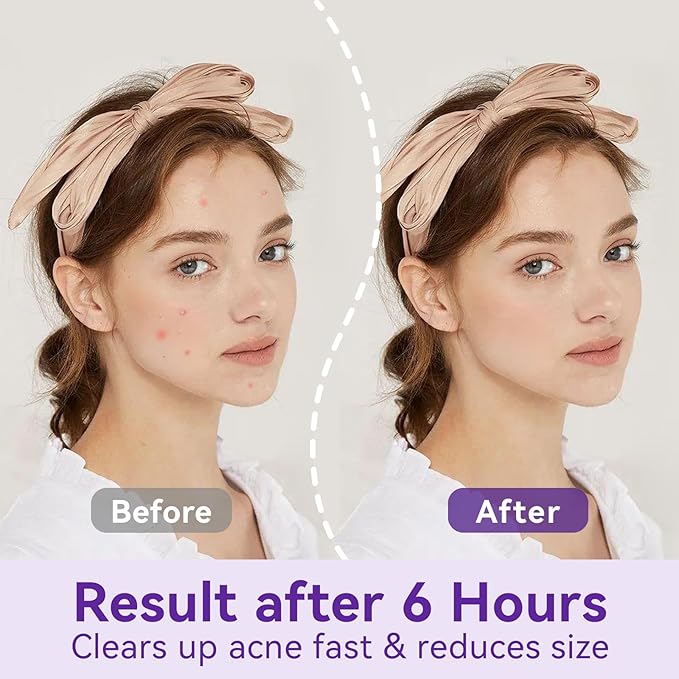 Pimple Patches for night (72 ptaches) - Hydrocolloid Acne Patch for night - 10mm&12mm invisible pimple patches - Overnight For Skin care - acne patches for face - Hydrocolloid pimple stickers