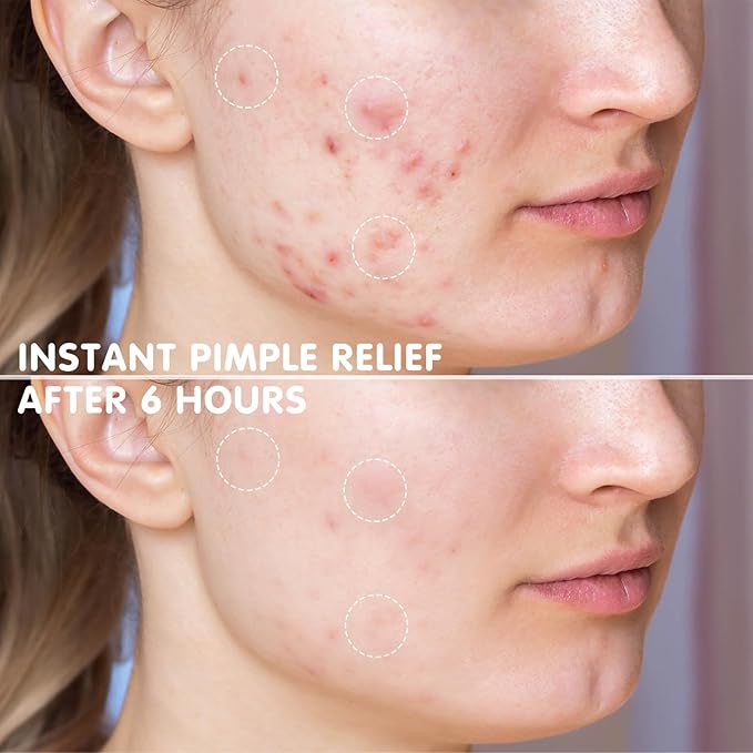 AUSLKA Star Pimple Patches - 150 Count - Hydrocolloid Pimple Patches,Cute Star Shape, Blue Colors,Spot Stickers For Face And Skin,Temporary Mirror