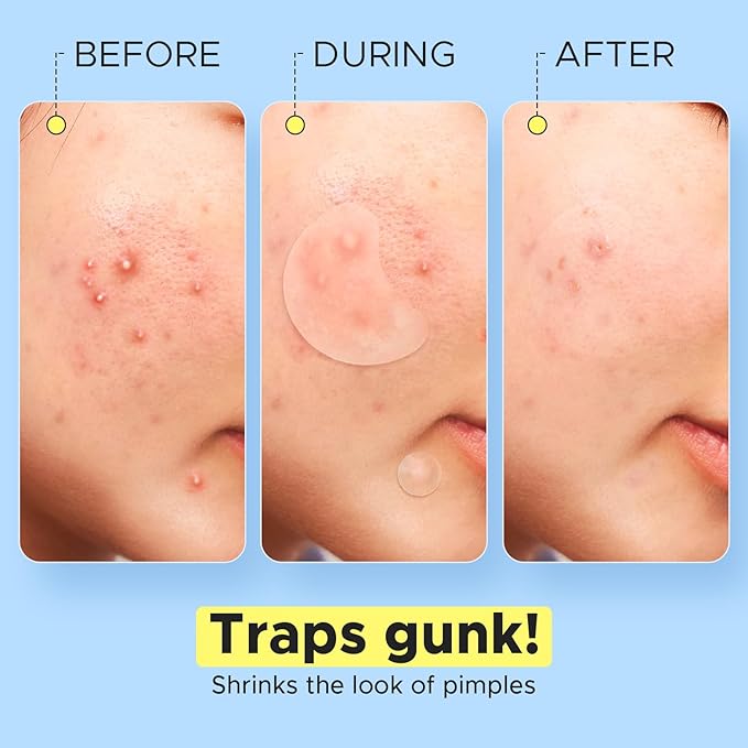 LitBear Pimple Patches for Face, Large Acne Patch, XL Hydrocolloid Bandages,Zit Stickers for Forehead, Chin, Nose, Body, Back, and Chest (5 Sizes, 228 Pimple Patches)