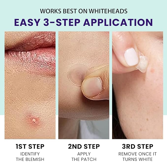 Pimple Patches for face and body | 36 Count (12mm), Invisible Hydrocolloid Acne patches – Face Stickers for Zits, dark spot , Blemishes, Pore strips, Forehead pimple patch , Invisible spot cover