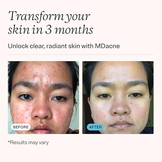 MDacne 3 Step Benzoyl Peroxide Acne Kit - Benzoyl Peroxide Cream 2.5%, Salicylic Acid Cleanser, Niacinamide Moisturizer - Medicated Plant-Based kit for Adult & Teen Acne, 60 Day Kit + Pimple Patches