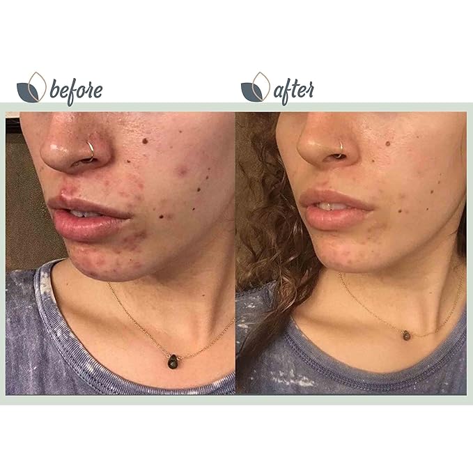 BioClarity 3-Step Acne Routine, Full Size, for Oily or Acne-Prone Skin, Clean Vegan Ingredients, Includes Cleanser, Salicylic Acid Acne Treatment Gel, Restorative Green Gel