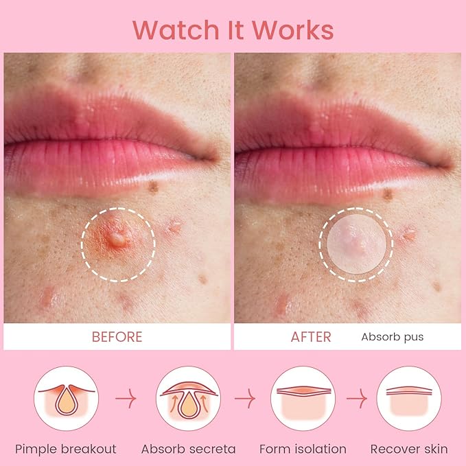 AUSLKA Pimple Patch Bulk, 720 Pimple Patches for Face, Hydrocolloid Spot Patch Stickers for Zits& Blemishes, Suitable for Body, Cheek, Forehead, Chin and Back (8mm, 10mm,12mm)