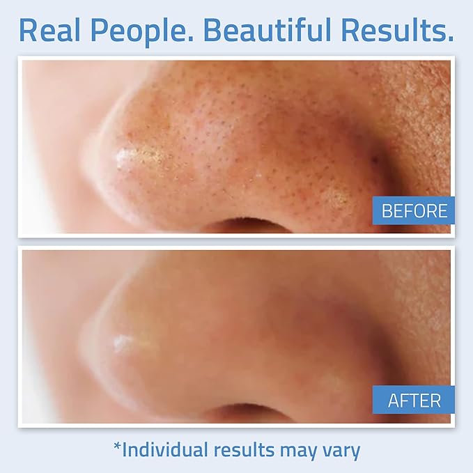 YEOUTH Salicylic Acid Peel for Face 20%, BHA Exfoliator for Clear Looking Skin, Gentle At Home Exfoliator for Face with Green Tea, Salicylic Acid Serum 1oz