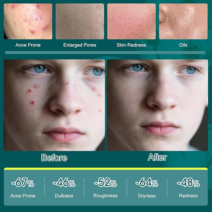 Skin Care Set,Acne Treatment for Face Skin Care Sets & Kits,Tea Tree Essential Oil Facial Skincare Gift Set with Cleanser,Toner,Serum,Gel, Acne Treatment Kit Cream Skin Care for Teens 10-12 Girls Boys