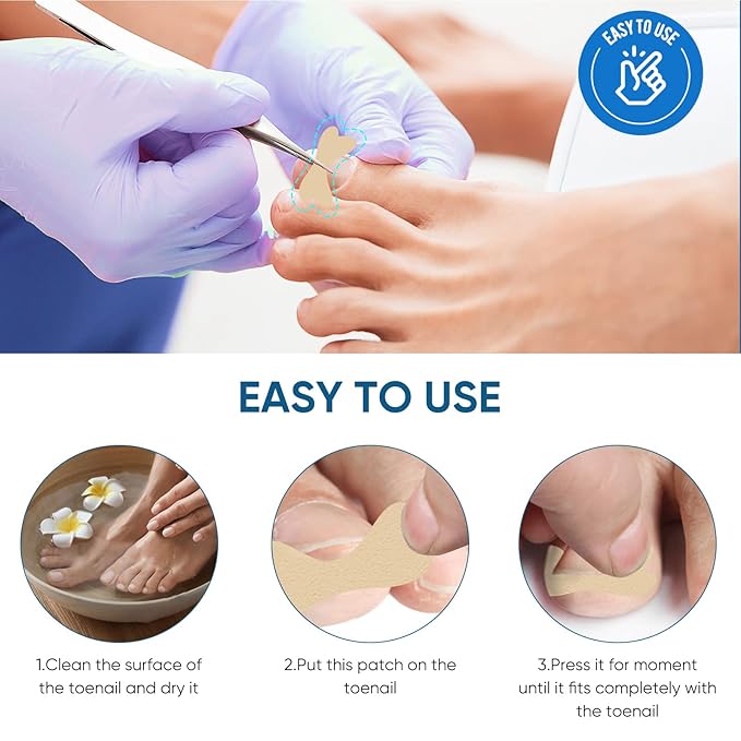 Ingrown Toenail Treatment, 60Pcs Ingrown Toenail