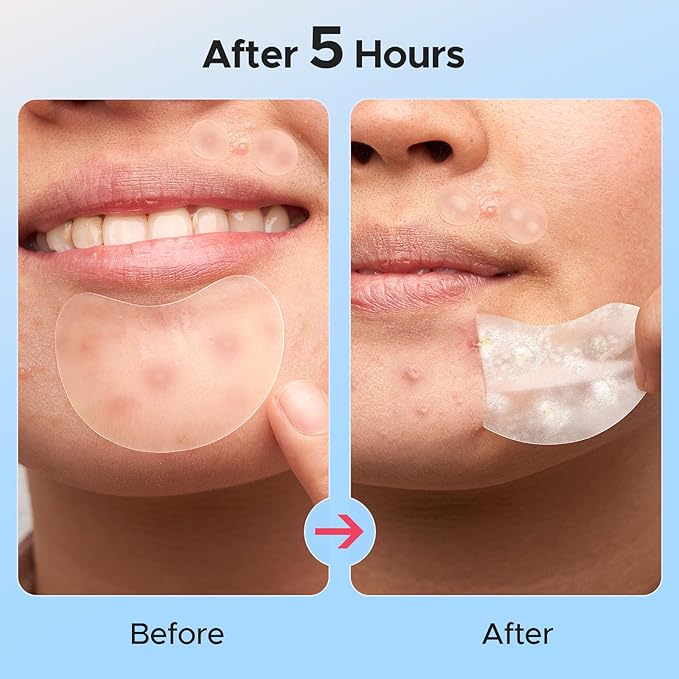 LitBear Large Pimple Patches, 5 Size 224 Count Big Acne Patches for Face, Chin, Forehead and Body, Zit Patches for Dots, Blemishes and Large Breakouts, Hydrocolloid Patch (XL Strip, Contoured, Round)