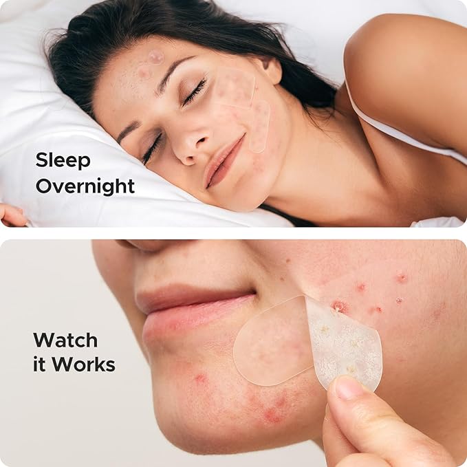 TKTK Hydrocolloid Bandages, 45 x 45 mm Large Pimple Patches for Face, XL Acne Patches for Body, Back, Forehead, Cheek Zit Breakouts, Big Hydrocolloid Patch (Square, Strip, Dot 5 Sizes 270 Count)