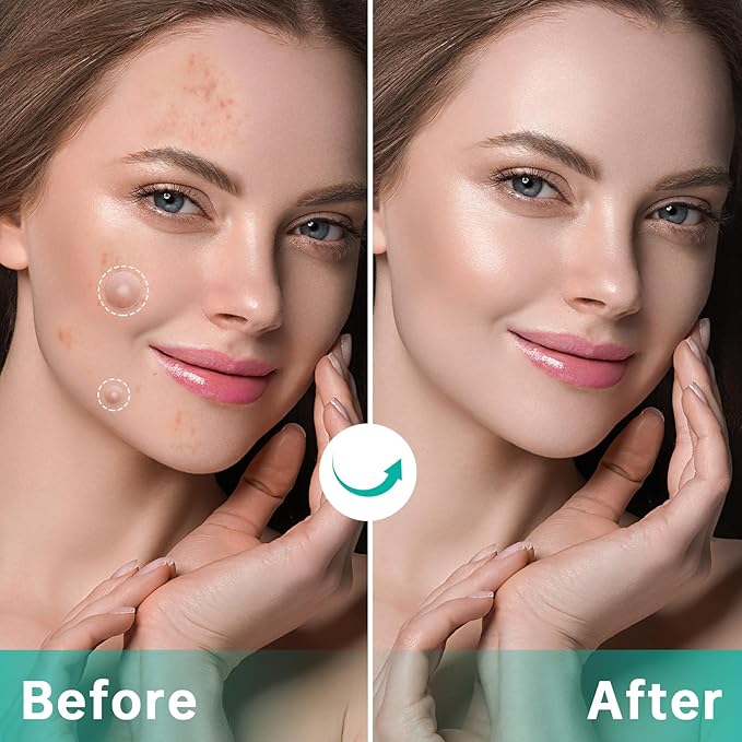 Pimple Patches for Face, Acne Patches/Hydrocolloid Patches for Covering Zits and Blemishes/Spot Care for Face,Absorb Fluid,4 size (210 Count)