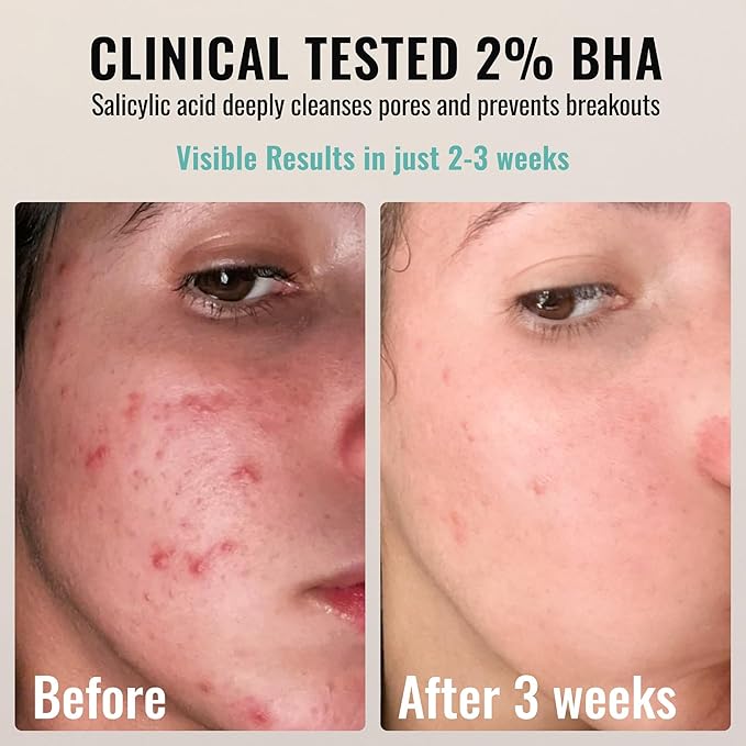 2% BHA AHA Liquid Salicylic Acid Exfoliant - Gentle Peel, Pore Minimizer, Face Exfoliator for blackheads, wrinkles with Hyaluronic acid - Fragrance-Free Hydrating for All Skin Types, 2oz