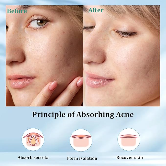 Pimple Patches for Face (36 Counts), Hydrocolloid Acne Patches for Face, Covering Blemishes, Invisible Pimple Patches, Round Shape Zit Covers, Not Tested on Animals, 2 Sizes