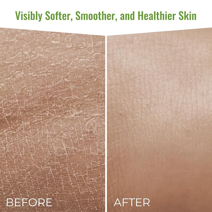 Moisturizing Eczema Body Wash – Gentle Psoriasis Body Wash for Itchy, Dry Skin Relief – Eczema Soap for Redness and Flareups – Hydrating Cleanser for Women and Men