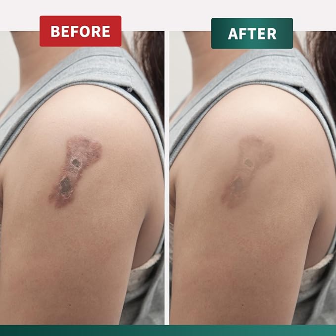 Protect Life Silicone Scar Cream for Surgical Scars, Injury & Keloid Scar Treatment, Moisturizing Scar Removal Cream, Rejuvenating Silicone Scar Gel