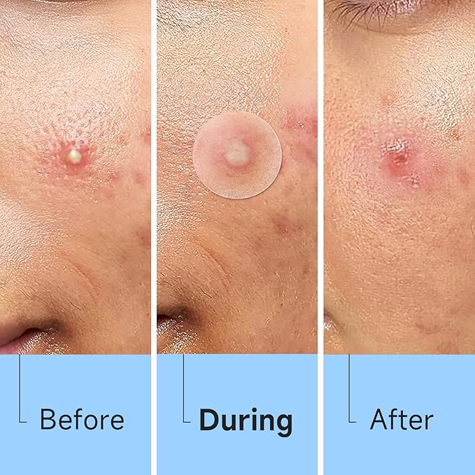 Acne Pimple Patch(840 Counts 4 Sizes), Zit Stickers for Face, Hydrocolloid Spot Stickers, Clear Acne Dots for Covering Zits, Blemishes, and Breakouts