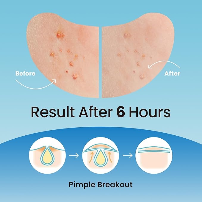 Large Pimple Patches for Nose Chin and Forehead Pores Breakout and Spot Treatment - Acne Patches for Face Hydrocolloid Acne Patches Zit Patches for Face Big Pimple Patches - 16 Patches XL