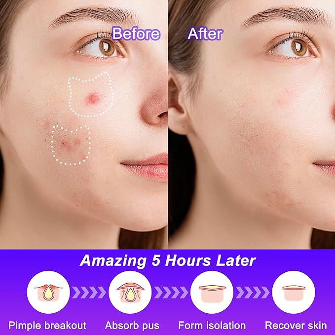 Pimple Patches,Acne Patches,Pimple Patches for Face, Cute Stickers,Salicylic Acid & Tea Tree, 120 Hydrocolloid Dots in 20 Colors for Face,Cute Cat Pimple Stickers