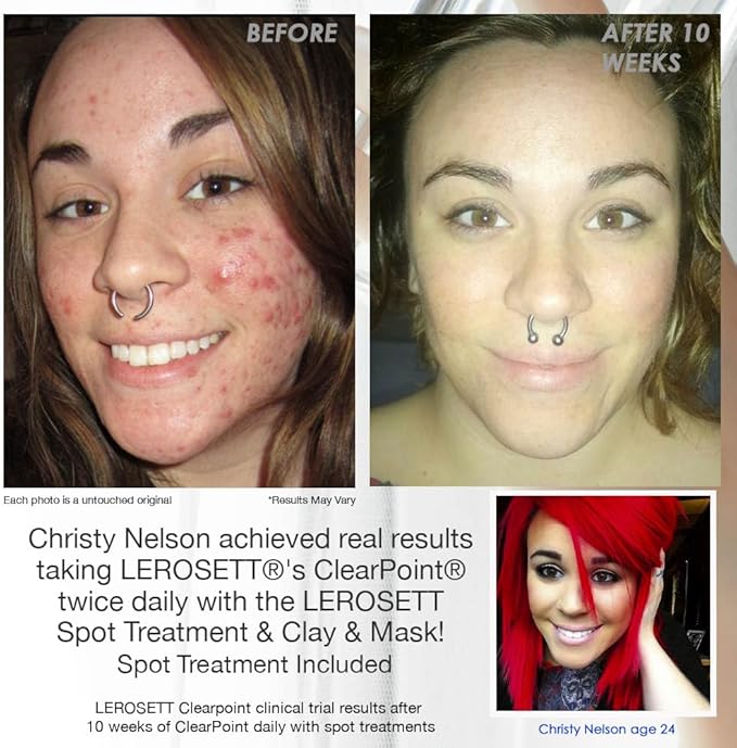 LEROSETT ClearPoint Anti Acne Pills, Natural Supplements for Hormonal & Cystic Acne Treatment for Oily Skin & Breakouts. 60 Caps